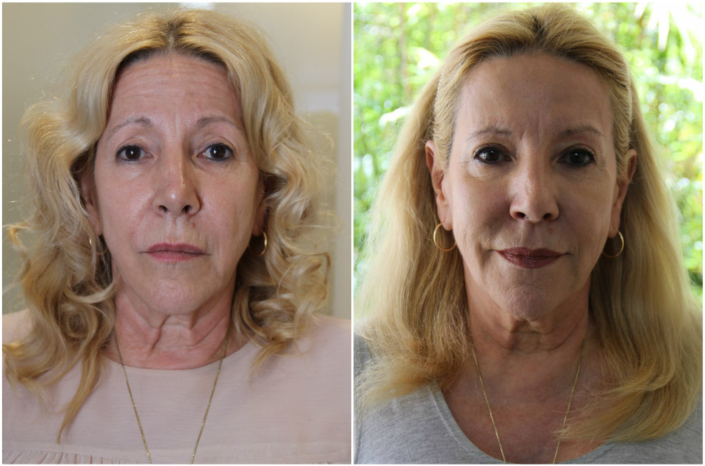 Dr. Michael Godin, injections, botox, fillers