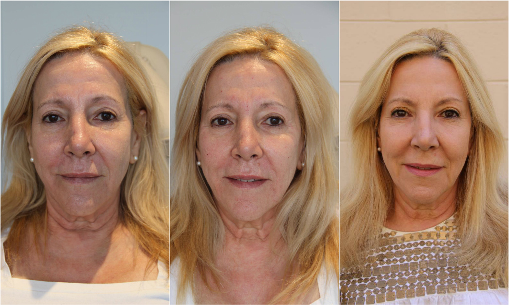 fillers, merz, boletero, nurse karen house, radiesse