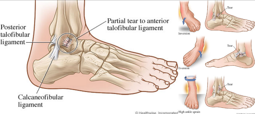 ankle injury prevention