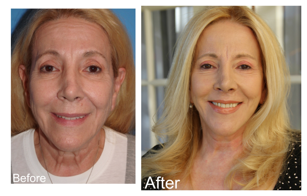 Michele Elyzabeth, dr. George sanders, face lift, neck lift, before and after