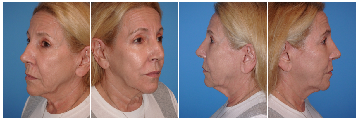 dr. George sanders, Michele Elyzabeth, face lift, neck lift