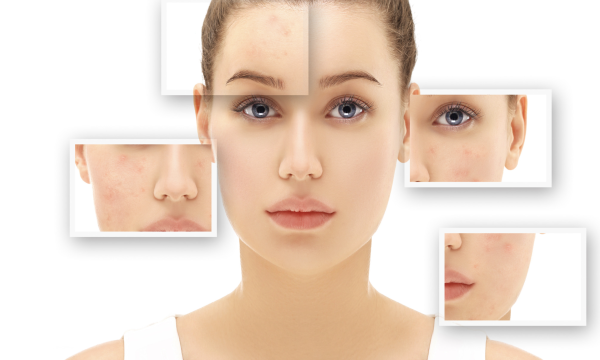 zit and pimple patches